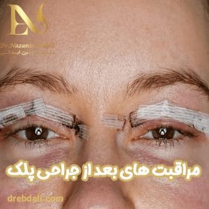 مراقبت های بعد از جراحی پلک - دکتر نازنین ابدالی -drebdali.com