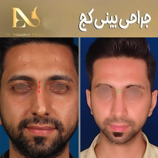 جراحی بینی کج - دکتر نازنین ابدالی