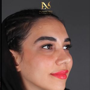 عکس نمونه کار عمل بینی عروسکی - دکتر ابدالی - drebdali.com