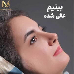 عکس نمونه کار عمل بینی فانتزی - دکتر ابدالی - drebdali.com