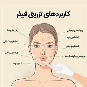 نواحی تزریق ژل - دکتر ابدالی 