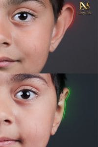 عکس عمل زیبایی گوش در مشهد-دکتر نازنین ابدالی - drebdali.com