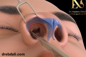 عکس جراحی بینی بسته - دکتر ابدالی - drebdali.com