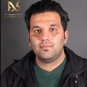 نمونه جراحی بینی مردانه در مشهد- دکتر ابدالی - /drebdali.com