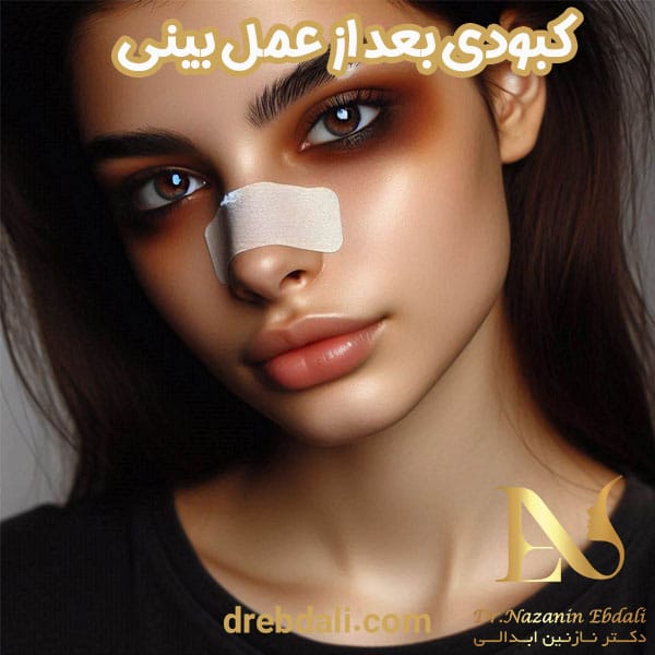 کبودی بعد از عمل بینی - دکتر نازنین ابدالی - drebdali.com