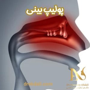 پولیپ بینی - دکتر نازنین ابدالی - drebdali.com