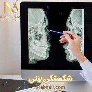 جراحی بینی شکسته - دکتر ابدالی - drebdali.com