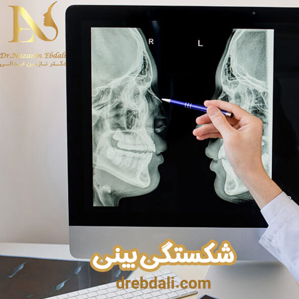 جراحی بینی شکسته - دکتر ابدالی - drebdali.com