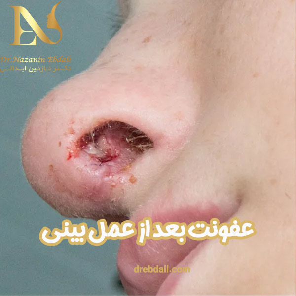عفونت بعد از عمل بینی - دکتر ابدالی -drebdali.com