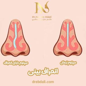 انحراف بینی - عمل انحراف بینی - دکتر ابدالی -drebdali.com