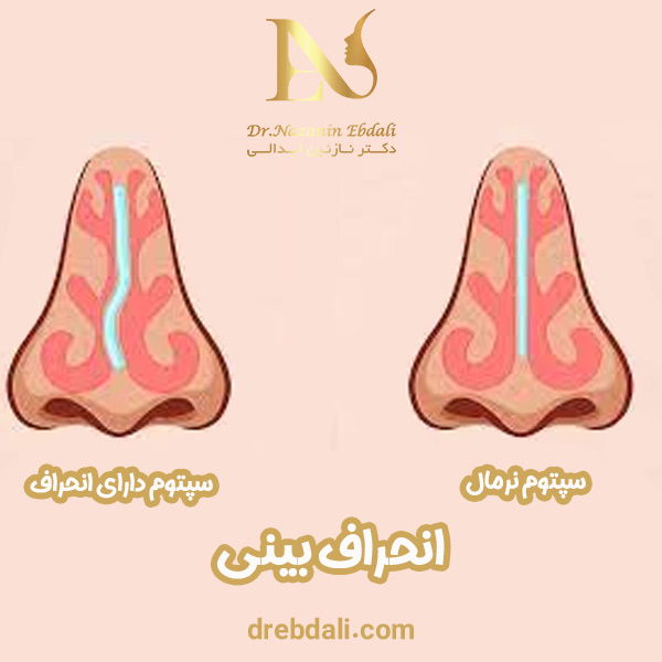 انحراف بینی - عمل انحراف بینی - دکتر ابدالی -drebdali.com