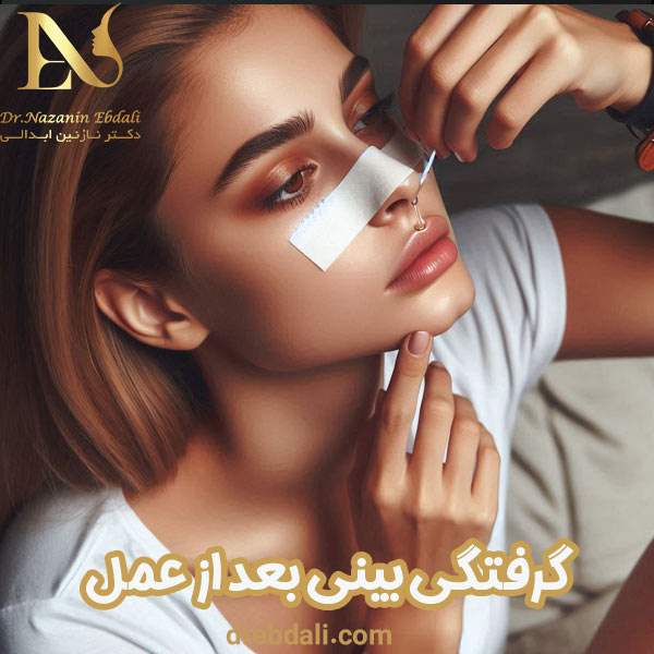 کیپ شدن بینی بعد از عمل - دکتر ابدالی - drebdali.com