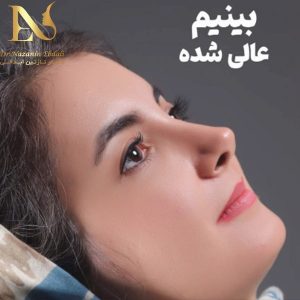 عکس جراحی بینی به روش باز - دکتر ابدالی - drebdali.com