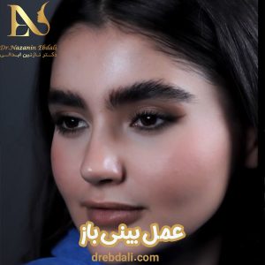 جراحی بینی باز - دکتر ابدالی - drebdali.com