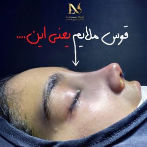 عکس عمل بینی نیمه فانتزی - دکتر ابدالی - /drebdali.com