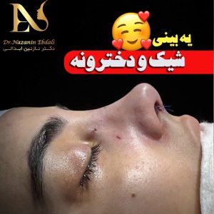 عکس نمونه کار جراحی بینی نیمه فانتزی - دکتر ابدالی -drebdali.com