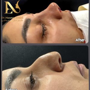 عکس قبل و بعد عمل بینی نیمه فانتزی - دکتر ابدالی drebdali.com