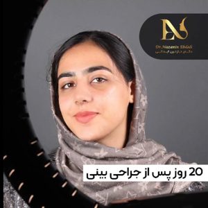 عکس جراحی بینی استخوانی - دکتر ابدالی - drebdali.com