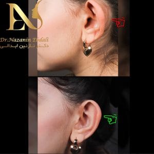 عکس قبل و بعد از اتوپلاستی - دکتر ابدالی -drebdali.com