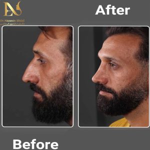 عمل کردن انحراف بینی - دکتر ابدالی - drebdali.com