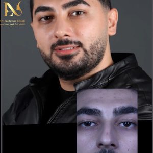 عمل انحراف بینی - دکتر نازنین ابدالی - drebdali.com