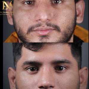 جراحی انحراف بینی - دکتر ابدالی -drebdali.com