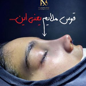 جراحی بینی مشهد - دکتر ابدالی - drebdali.com