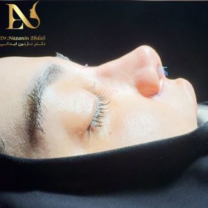 عمل بینی مشهد - دکتر ابدالی - drebdali.com