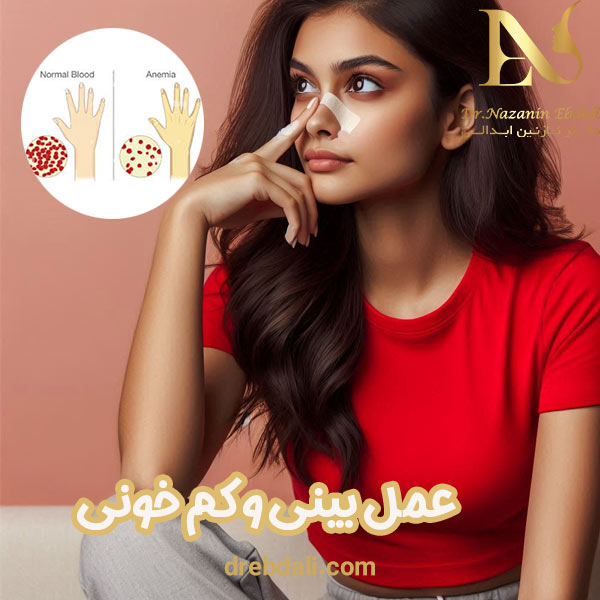 عمل بینی و کم خونی - دکتر ابدالی - drebdali.com