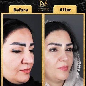 تصویر نمونه جراحی بینی در مشهد