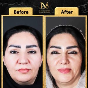 نمونه عمل بینی در مشهد