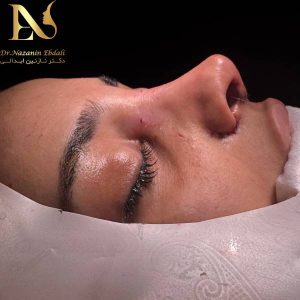 جراحی بینی در مشهد