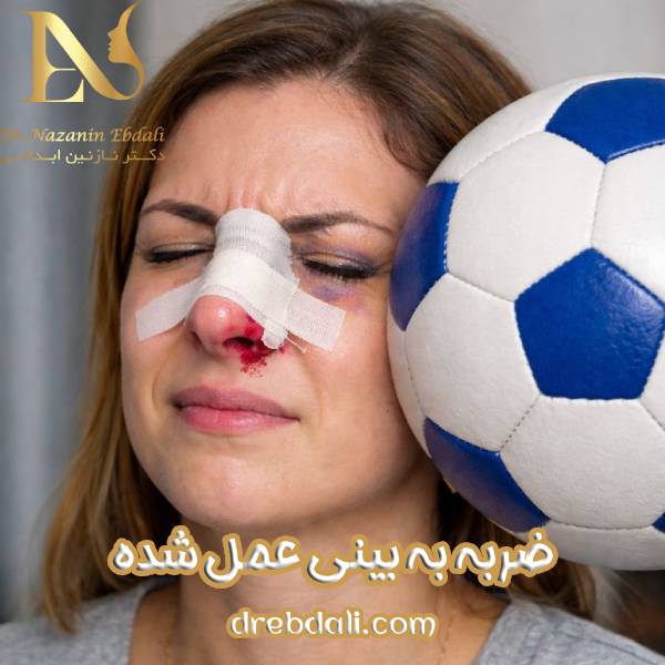 ضربه به بینی عمل شده