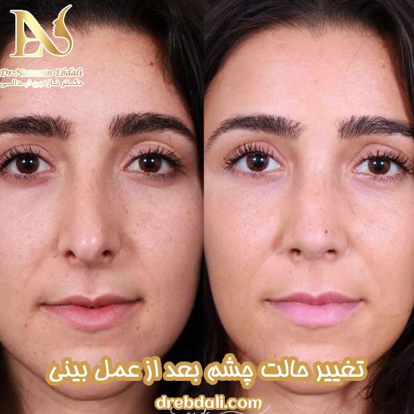 تغییر حالت چشم بعد از عمل بینی