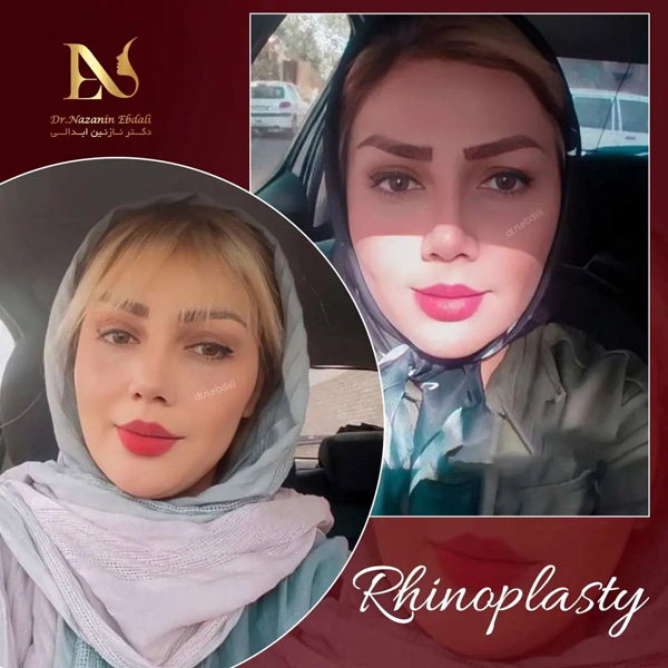جراحی-ترمیمی بینی - دکتر ابدالی - drebdali.com