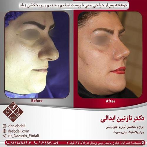 جراحی-بینی-10