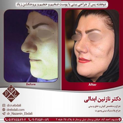جراحی-بینی-11