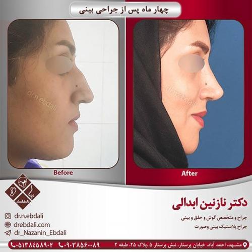 جراحی-بینی-21