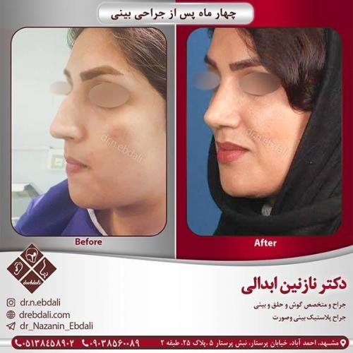 جراحی-بینی-22