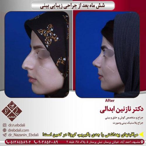 جراحی-بینی-401
