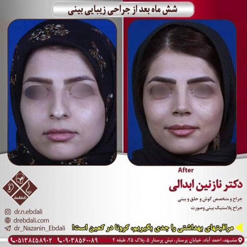 جراحی-بینی-402