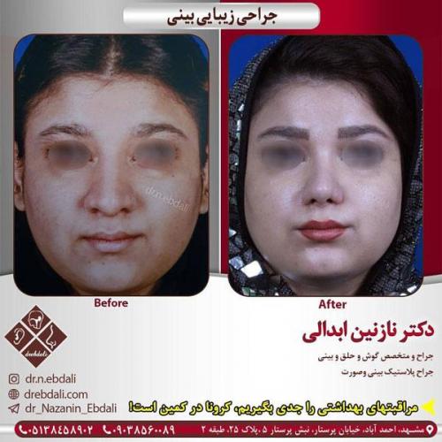جراحی-بینی-403