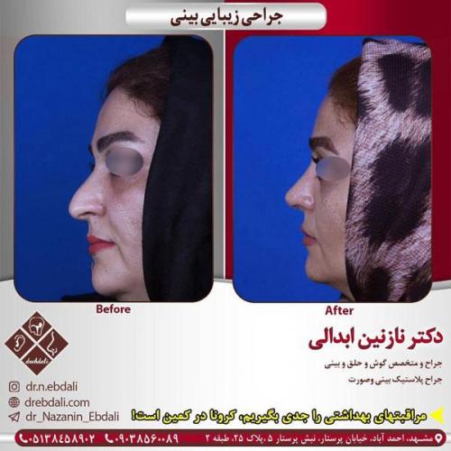 جراحی-بینی-404