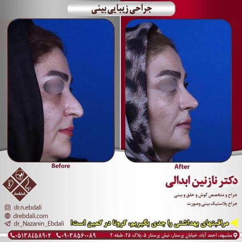 جراحی-بینی-405