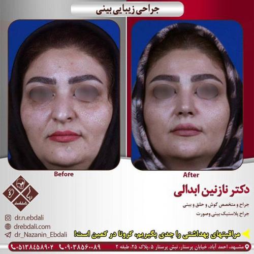 جراحی-بینی-406