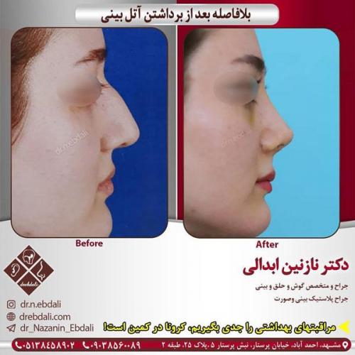 جراحی-بینی-407