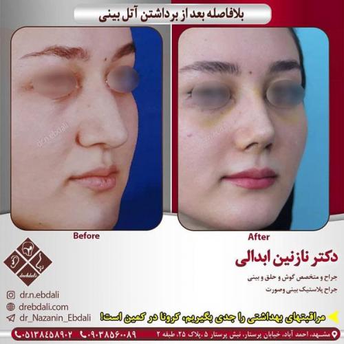 جراحی-بینی-408