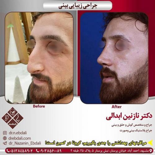 جراحی-بینی-409