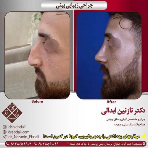 جراحی-بینی-410