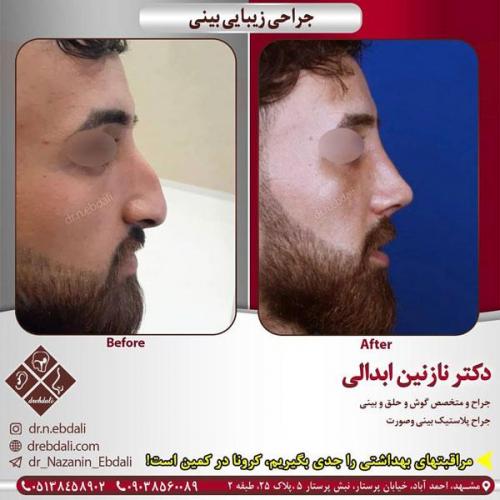جراحی-بینی-411